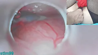 Japanese Insemination with Cum into Uterus and Endoscope Camera wits Cervix to watch inside womb Uncensored